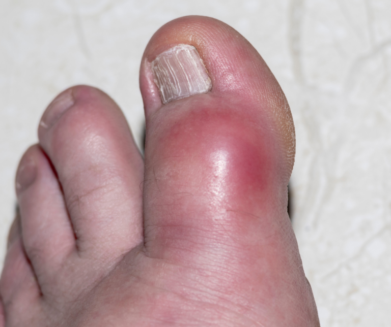 The “Carnivore” Toe:
