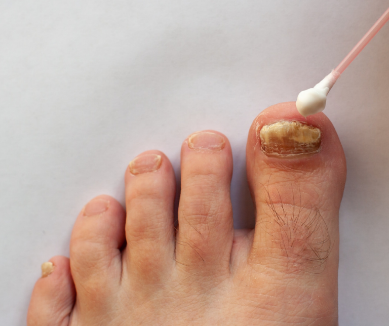 applying medication to toenail fungus